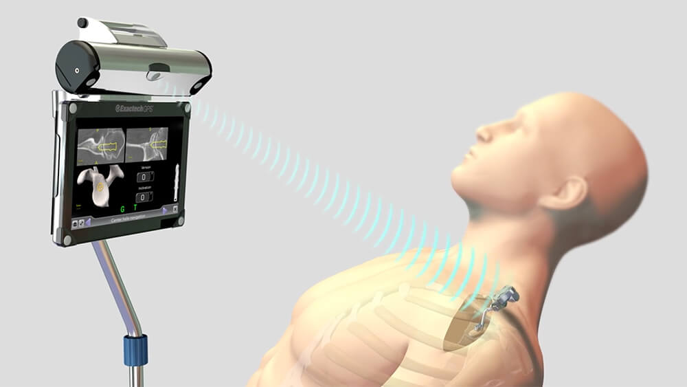 La tecnologia di pianificazione e navigazione della protesi di spalla
