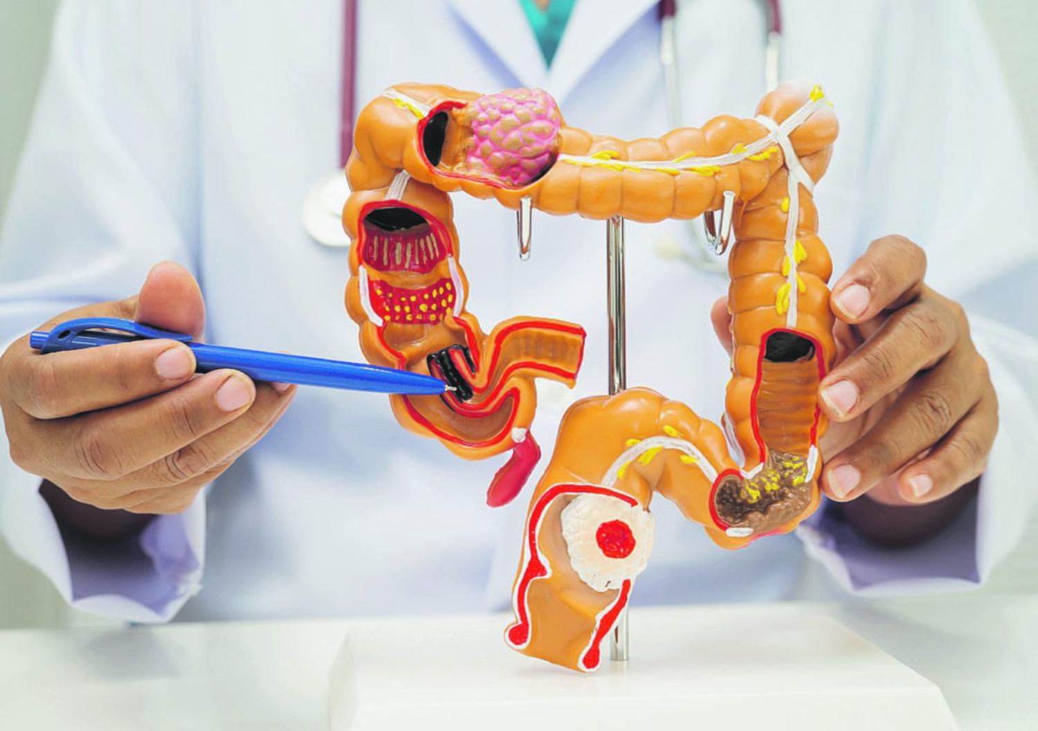 Tumore del colon-retto: perché la prevenzione può salvare la vita