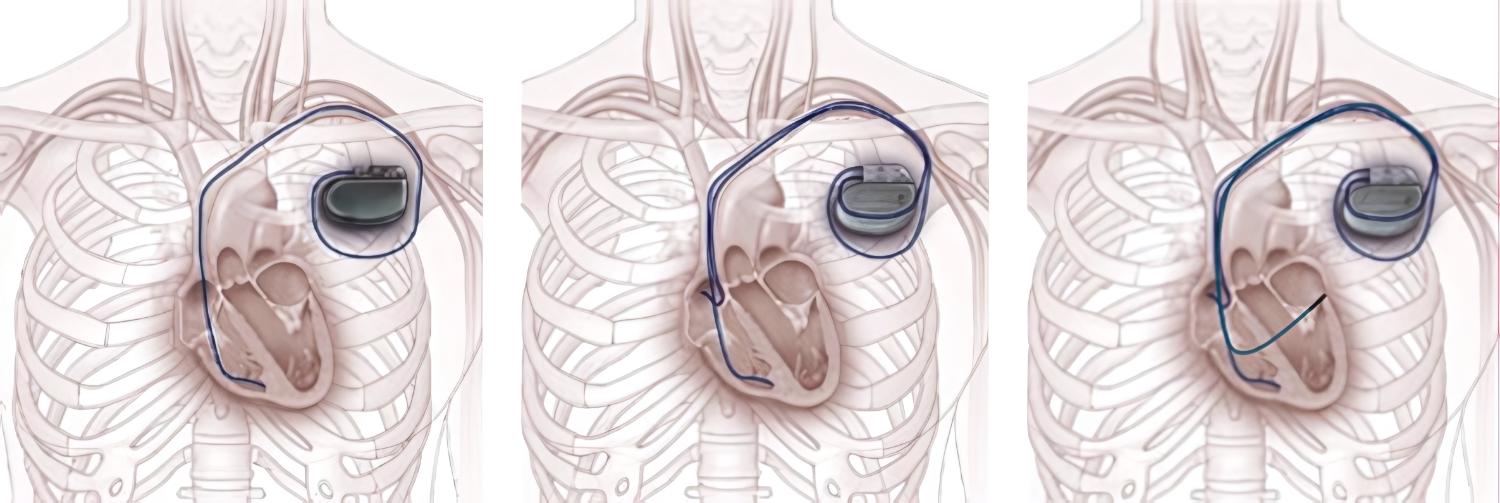 Controllo Pacemaker e Defibrillatori